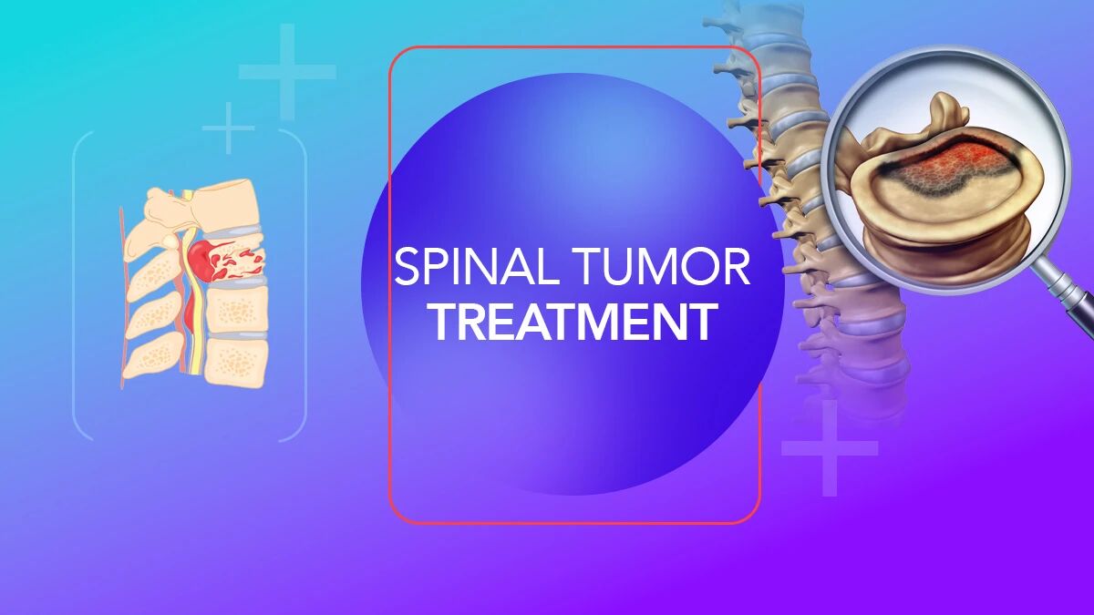 Spinal Tumors: Causes, Symptoms, Diagnosis, and Advanced Surgical Treatment