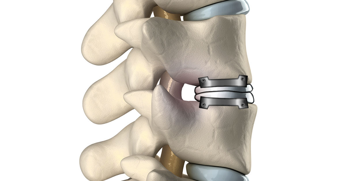 north-karnatakas-first-artificial-disc-replacement-surgery-by-dr-vijaymahantesh-pujari-in-hubli-thumbnail